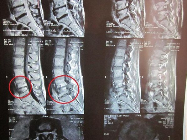Диагностика на цервикална остеохондроза