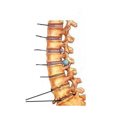 Как се развива остеохондрозата