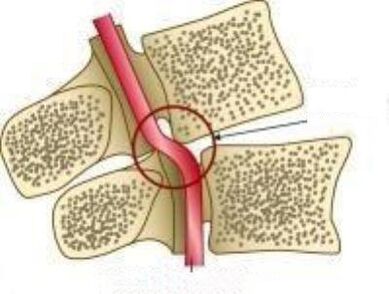 Синдром на Vail Artery