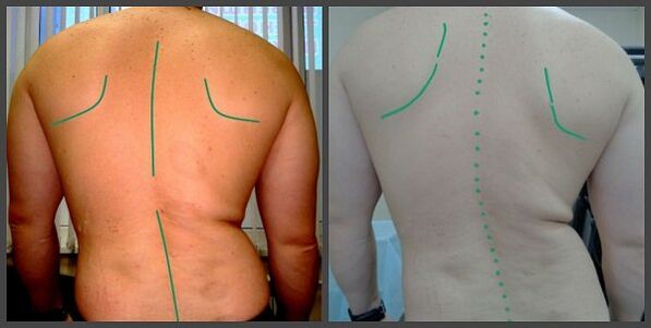 кривина на гръбначния стълб с остеохондроза