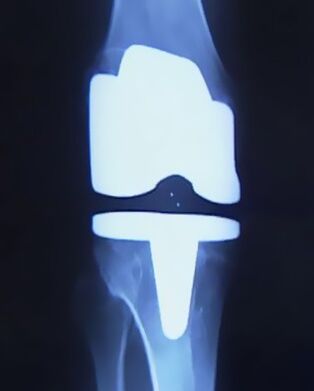 X -Райната снимка на коляното с изкуствена протеза след операцията за промяна на ставата