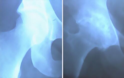 Измет от артроза на колянната става