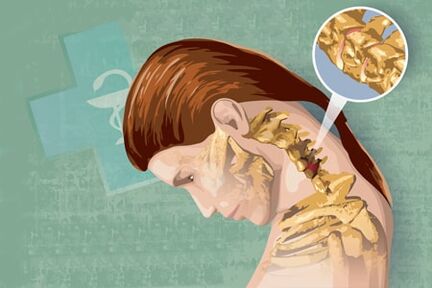 Рефлексни симптоми на остеохондроза